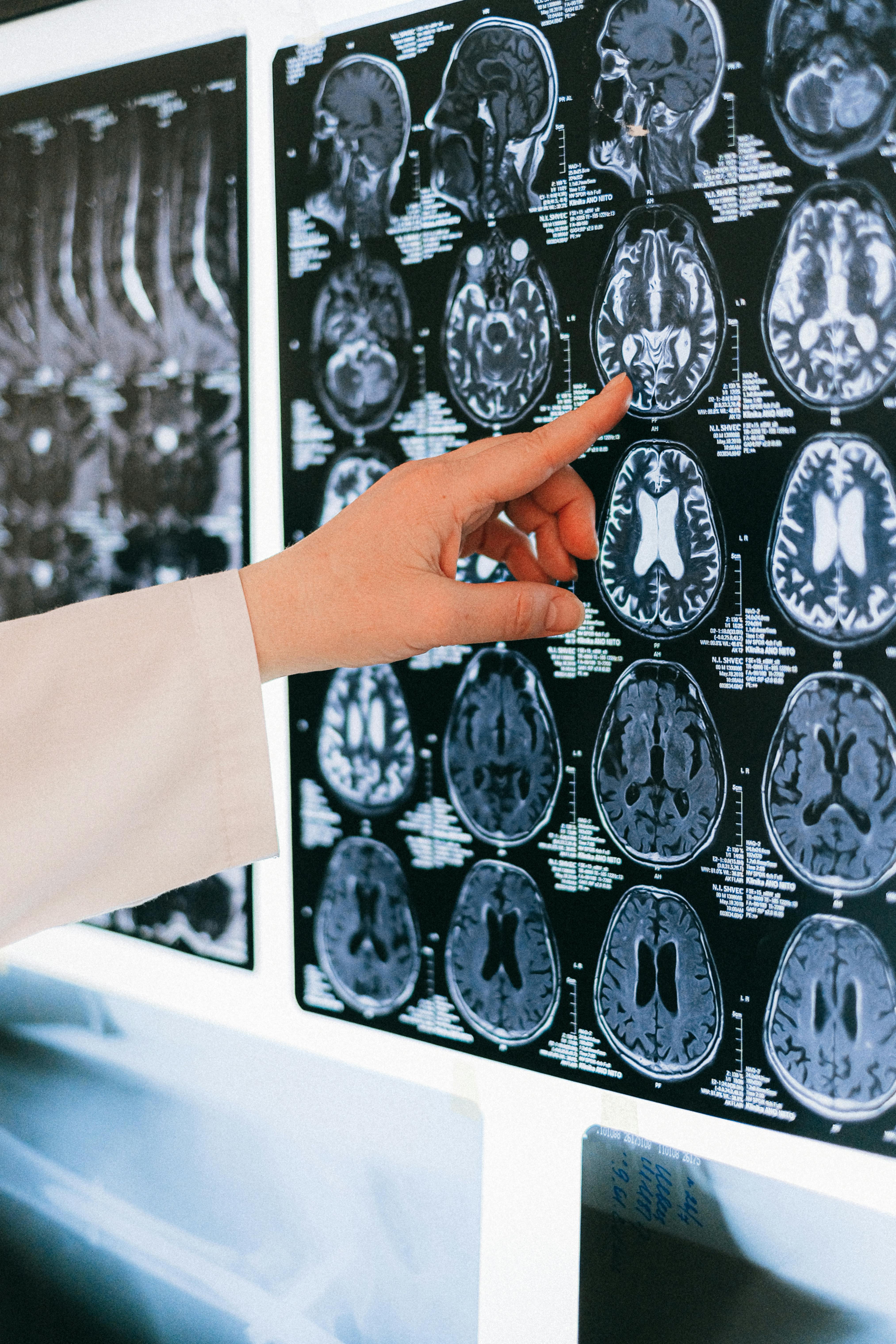 Accompagnement somatopathie troubles neurologiques fonctionnels